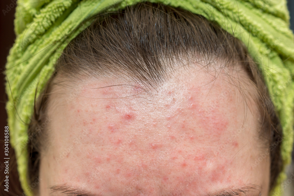 Irritation And Pimples On Skin Of Girls Forehead Stock Photo Adobe Stock