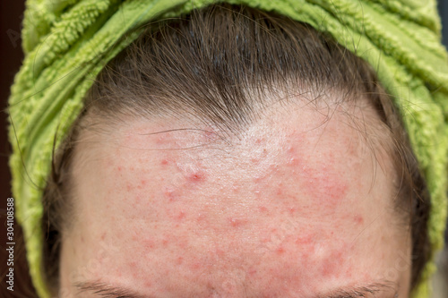 Irritation and pimples on skin of girls forehead