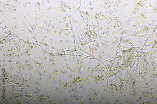 Picture of fungus and red blood cells in hemoculture tube, analyze by microscope 400x, specimen from HIV/AIDS patient photo