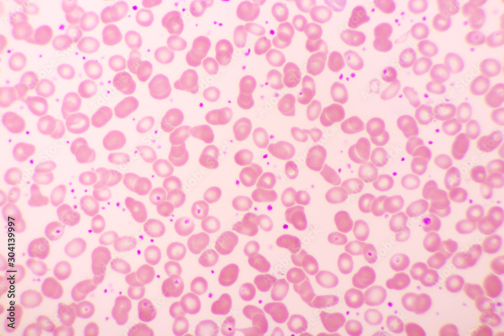 Essential thrombocytosis blood smear, present abnormal high platelet, analyze by microscope