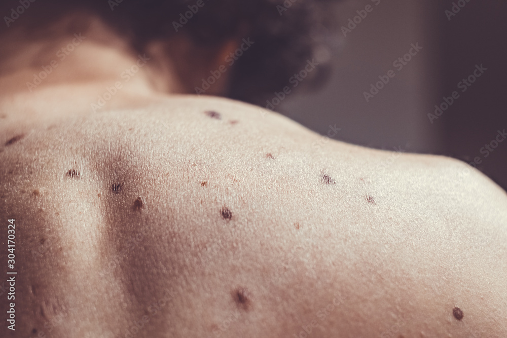Fototapeta premium Melanocytic nevus, some of them dyplastic or atypical, on a caucasian man of 37 years old from Spain
