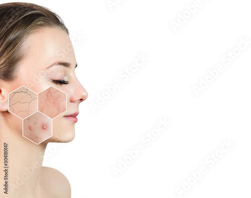 Zoom hexagon shows skin problems with couperose and acne.