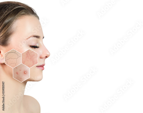 Zoom hexagon shows skin problems with couperose and acne. photo