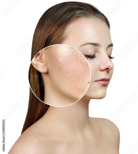 Young woman with zoom circle shows dry facial skin. photo