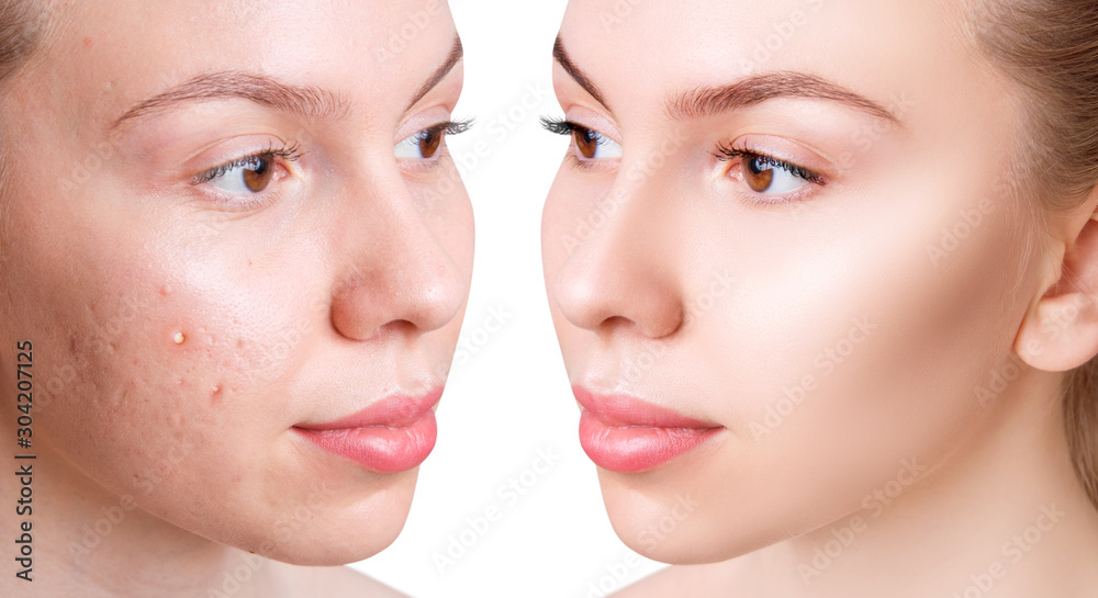 Face of beautiful woman before and after acne treatment. Face of beautiful woman before and after acne treatment.