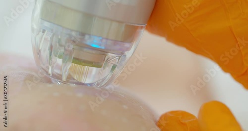 close-up. microneedle RF lifting procedure. Hardware cosmetology. Beautician conducts a facial rejuvenation procedure for a woman. photo