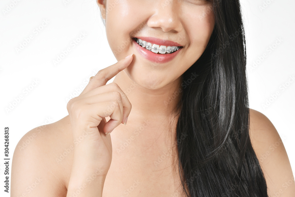 Beautiful women wearing braces in white isolated background. Beautiful women wearing braces in white isolated background.