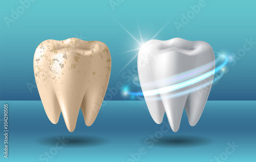Clean and dirty tooth before and after whitening