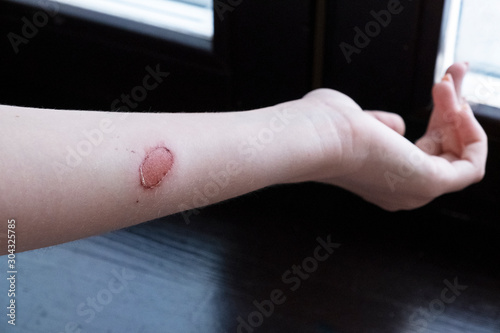 Second degree burn of a woman's hand.