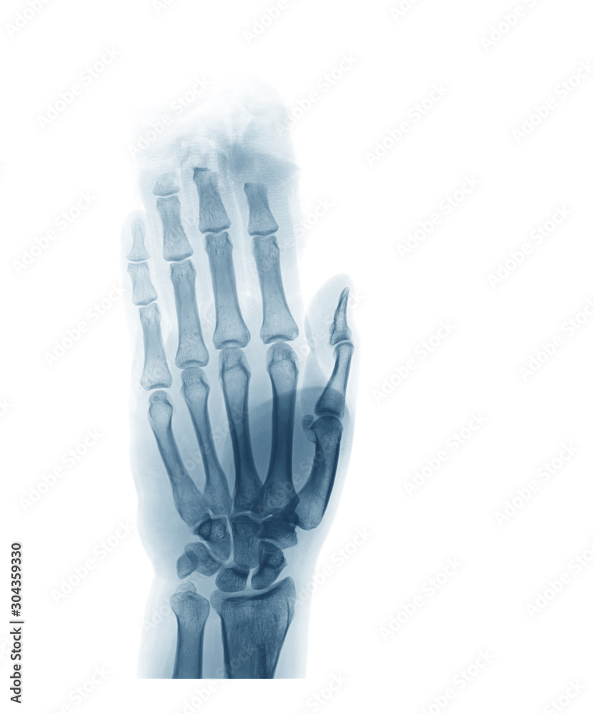 X-ray image of hand, show the fingertips were cut by a saw
