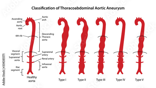 Classification of Thoracoabdominal Aortic Aneurysms. Healthy aorta with main parts labeled and aorta with various types of Thoracoabdominal aneurysm. Vector illustration in flat style