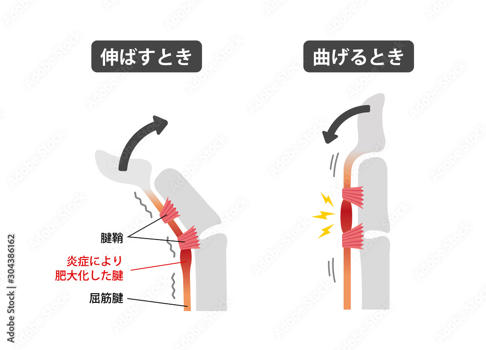 ばね指 バネ指 弾撥指 原因と症状 骨格解剖図イラスト 日本語 Stock Vector Adobe Stock