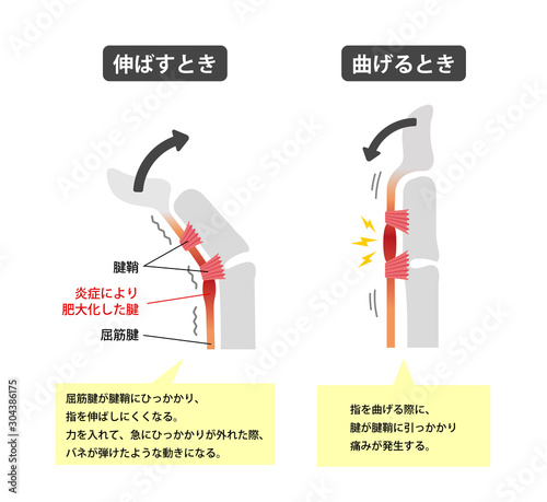 Trigger finger causes and symptoms illustration / Japanese (with explanation texts) 