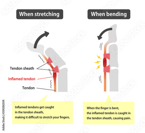 Trigger finger causes and symptoms illustration / English (with explanation texts)