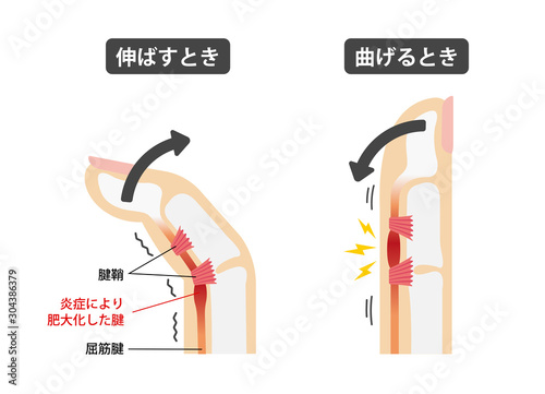 ばね指・バネ指 (弾撥指) / 原因と症状　骨格解剖図イラスト / 日本語