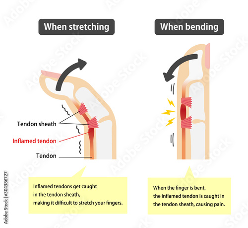 Trigger finger causes and symptoms illustration / English (with explanation texts)