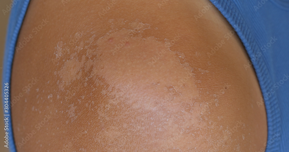 Fototapeta premium Sunburned skin, peeling skin from a sunburn