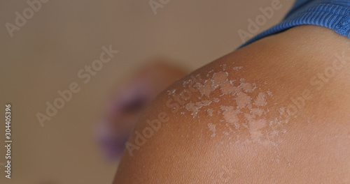 Sunburned skin, peeling skin from a sunburn
