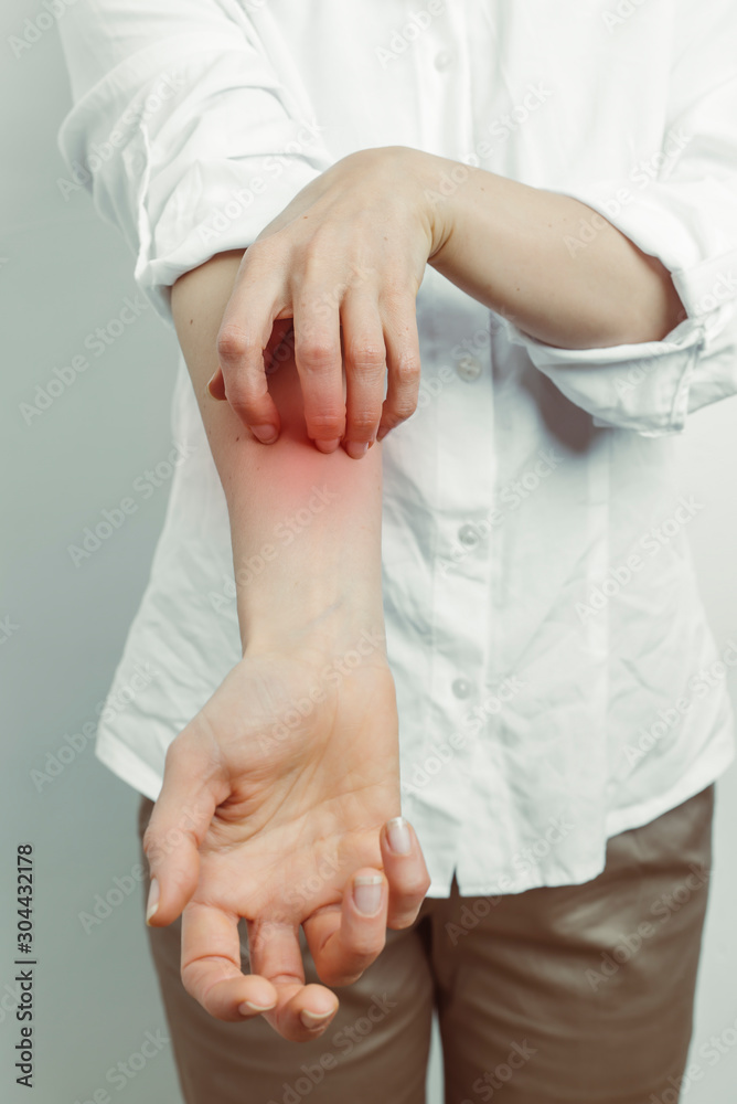 Woman scratches her hands. Scabies, allergies. Woman scratches her hands. Scabies, allergies.