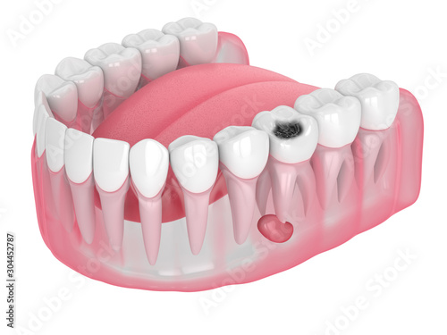 Photography 3d render of jaw with tooth cavity and cyst