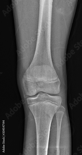 normal radiography of the knee joint in lateral projection, medical diagnostics, traumatology and orthopedics