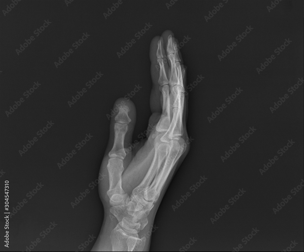 normal radiography of the shoulder joint and ribs in direct projection, Traumatology and orthopedics, traumatology, sports injury normal radiography of the shoulder joint and ribs in direct projection, Traumatology and orthopedics, traumatology, sports injury