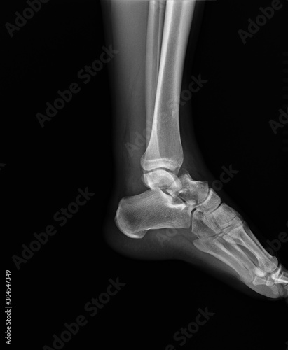 normal radiography of the ankle joint in lateral projection  traumatology and orthopedics  rheumatology