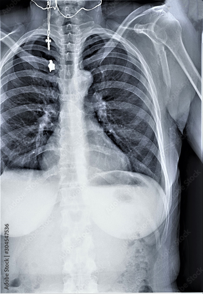 normal radiography of chest organs in direct projection, Traumatology and orthopedics, pulmonology normal radiography of chest organs in direct projection, Traumatology and orthopedics, pulmonology