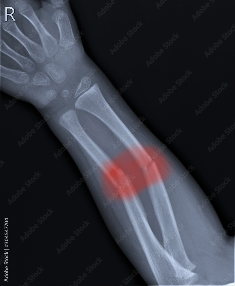 radiography of the forearm with a fracture of the radius and ulna ...