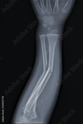 radiography of the forearm with a fracture of the radius and ulna  Traumatology and orthopedics  traumatology