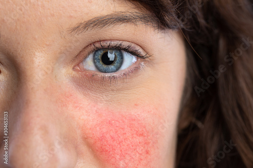 A beautiful young caucasian lady is seen up close and from the front, detailed view of blue iris, red blotchy cheeks symptomatic of couperose