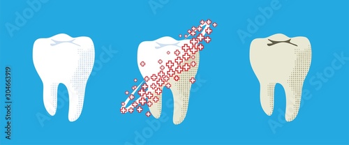 Caries or tooth decay treatment concept. Bad unhealthy and white healthy tooth. Cleaning and whitening teeth