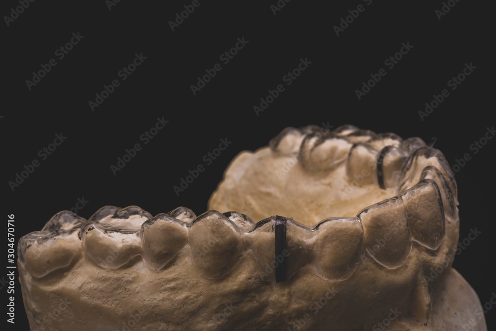 clear aligner or retainer for the teeth for orthodontic patients on a model 