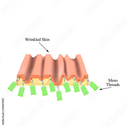 Mesotherapy Threads Lifting. threads for facelift. The structure of the skin. Wrinkles. Infographics. Vector illustration on isolated background.