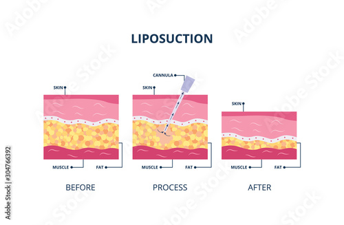 Suction-assisted liposuction procedure - skin layers vector illustration isolated.