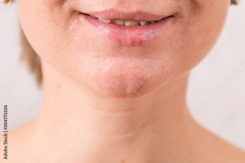 Fototapeta premium Close-up of female lips suffering from herpes