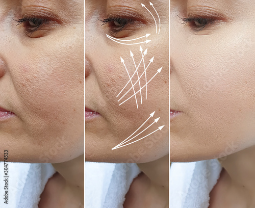 Fotografie woman wrinkles face before and after treatment arrow