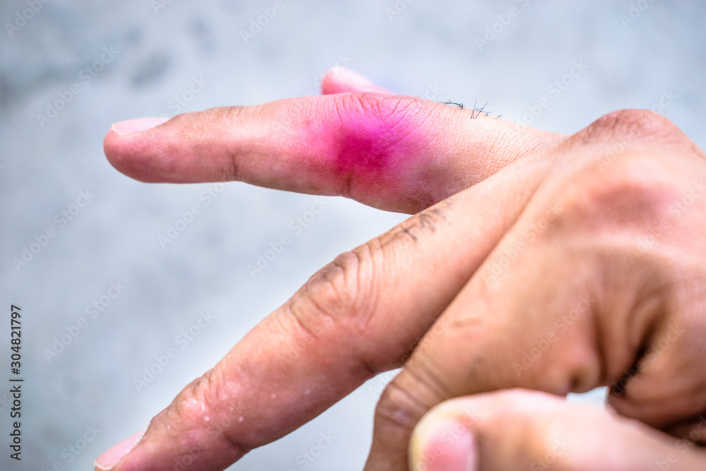 swelling and pain in the middle joint of ring finger and it's became red swelling and pain in the middle joint of ring finger and it's became red