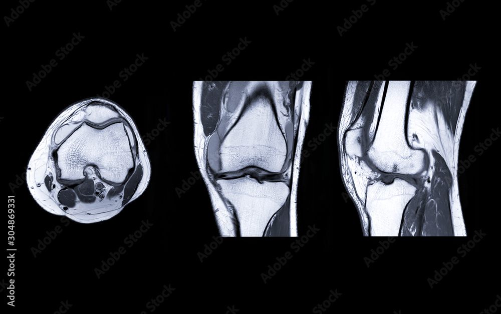 MRI Knee joint 3view Stock Photo | Adobe Stock