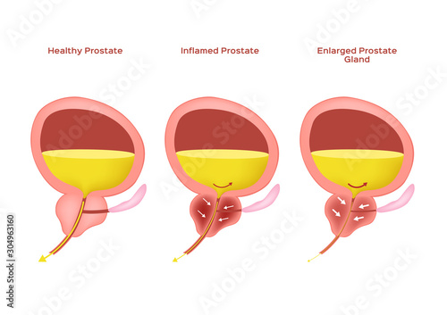 Inflamed prostate and Enlarged prostate gland / benign prostatic hyperplasia , bph vector