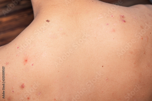 Pimples, blackheads and moles, on the back of a young man