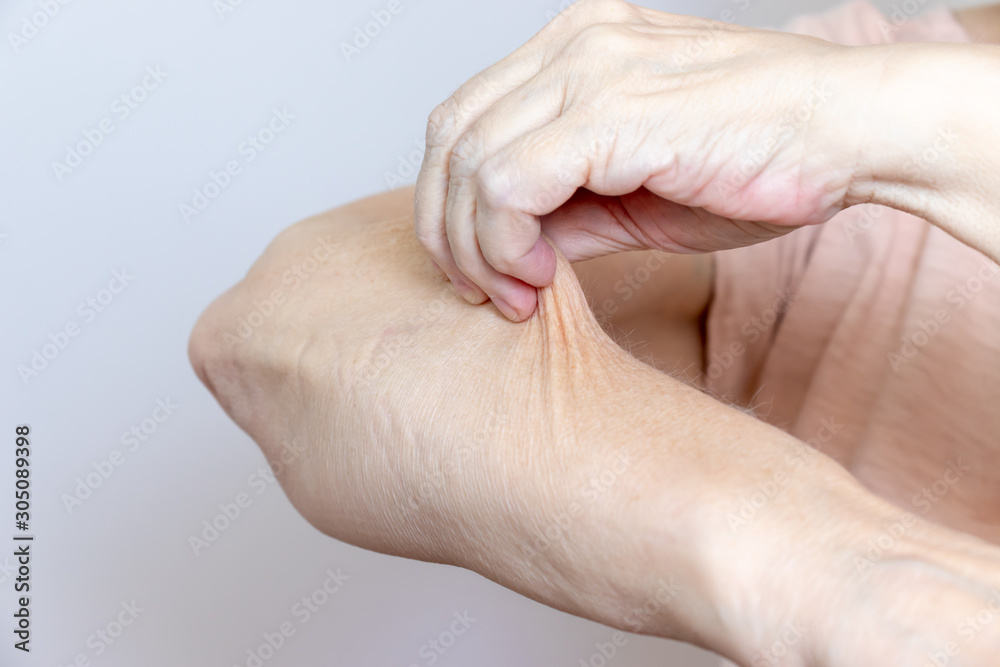 A senior elderly woman holding, pulling the skin on her arm with bad  turgor, exces loose skin Stock Photo | Adobe Stock