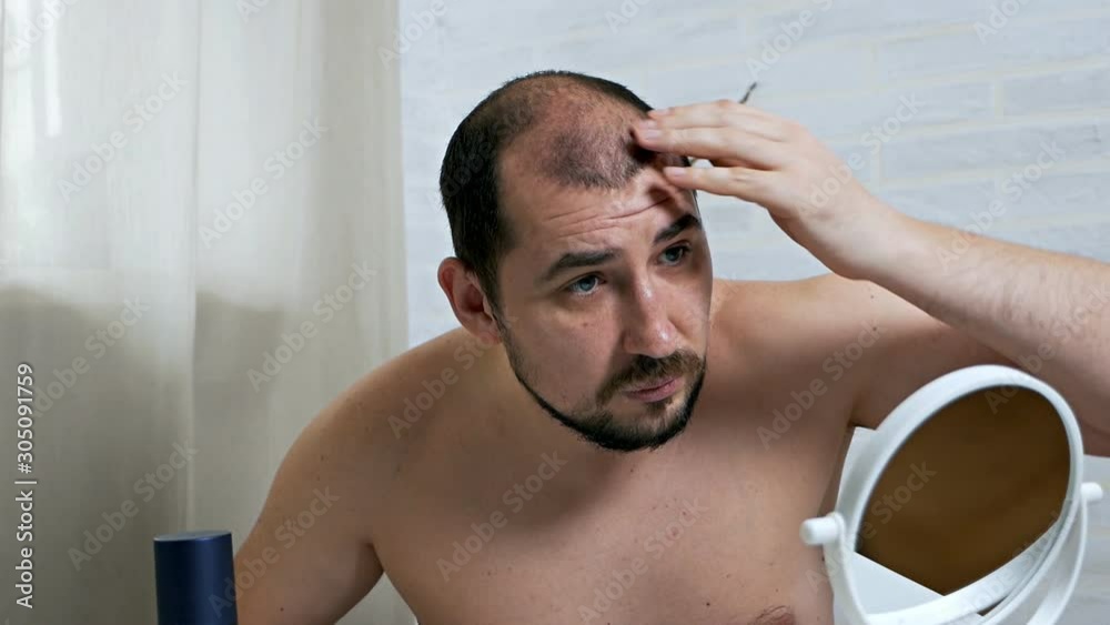 Worrying about hair loss.A balding man in front of a mirror takes care of his hair, uses a means for hair growth in case of hair loss. Worrying about hair loss.A balding man in front of a mirror takes care of his hair, uses a means for hair growth in case of hair loss.