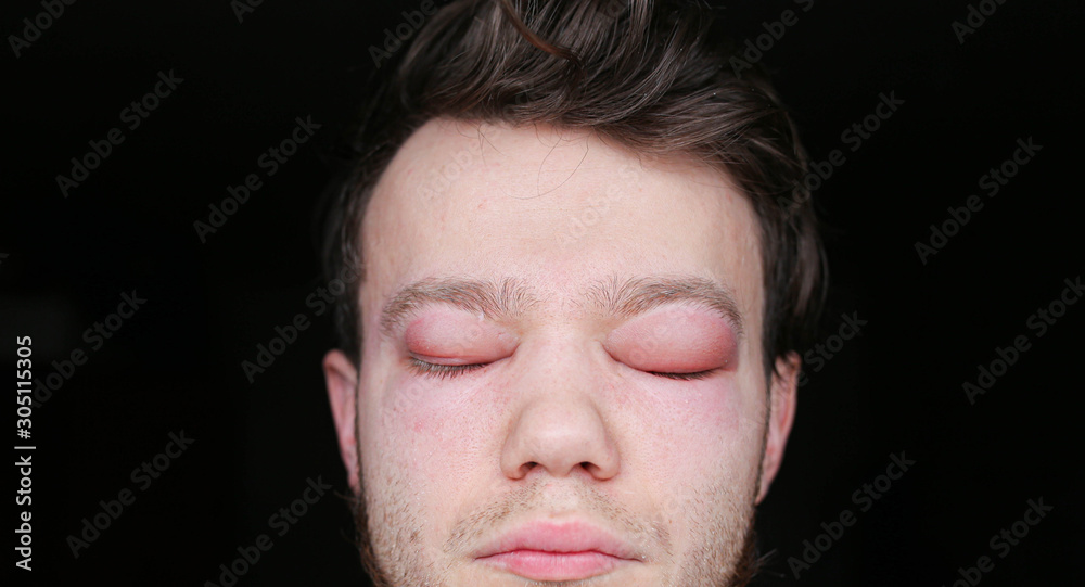 two inflamed red blood eyes of a man affected by conjunctivitis or after the flu, cold or allergy. two inflamed red blood eyes of a man affected by conjunctivitis or after the flu, cold or allergy.