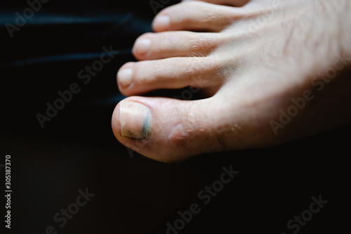 A mans foot with the large toe broken in a sporting injury with a discoloured/black toe nail.