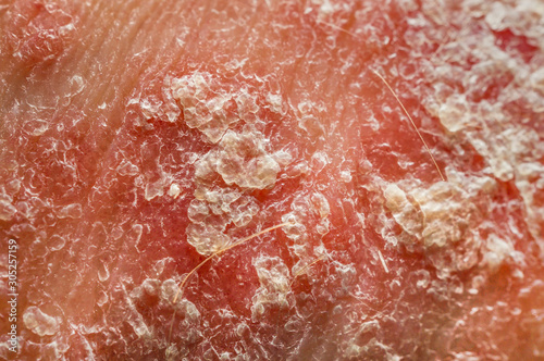 Psoriasis Vulgaris. Skin of a psoriasis patient close-up. Macro, shallow depth of field.