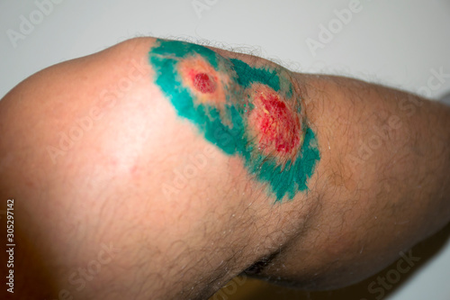 Bruise injury on young man knee. Close up image of male person sitting and examining wounded leg with fester. Wound infection concept. Wound in the male leg.