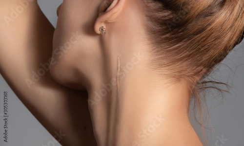 Photo Woman with surgery scar at her neck.