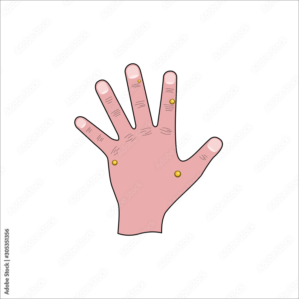 Obraz premium Wart removal medical illustration, human left hand affected by papilloma virus