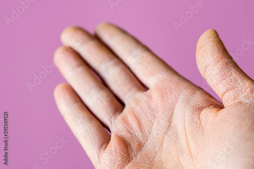 Women's hands  close-up, dry skin
